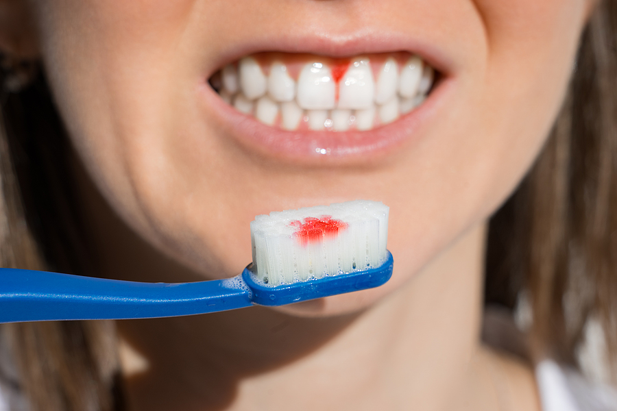 Gum Disease Awareness