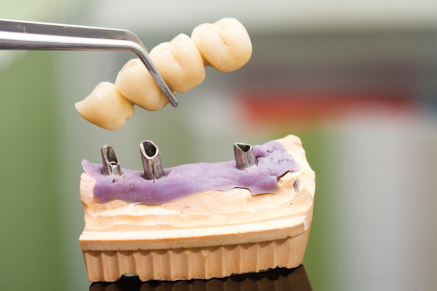 Dental Implants in Framingham, MA
