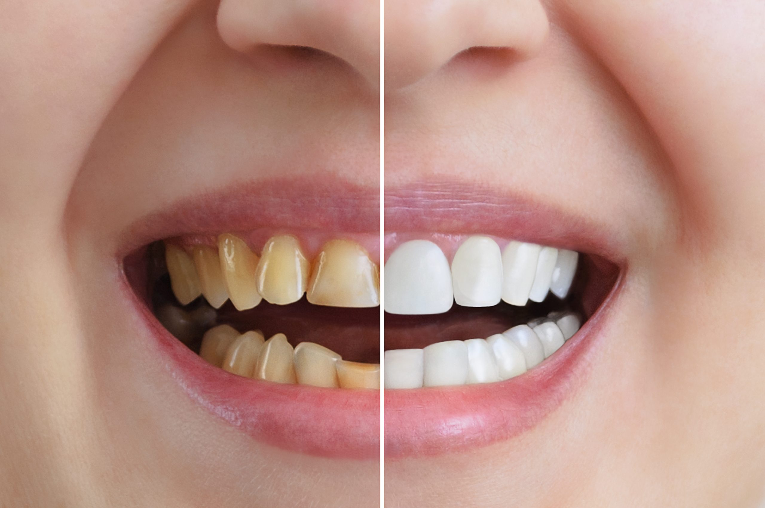 How to Maintain Your Results after Teeth Whitening